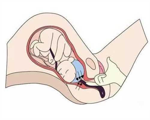 合肥晴天助孕：代孕早期五种肚子疼哪种
