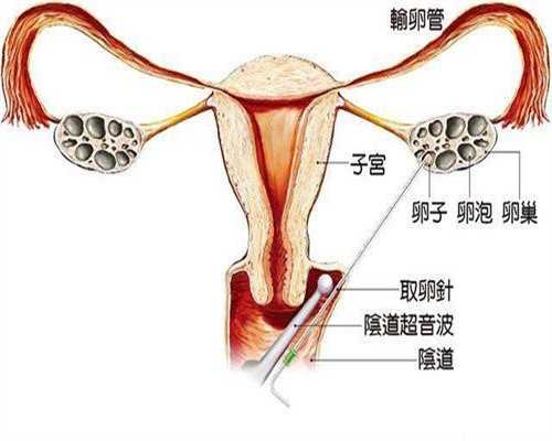 合肥代孕操作流程：爱尔兰女子4次代孕均流产放
